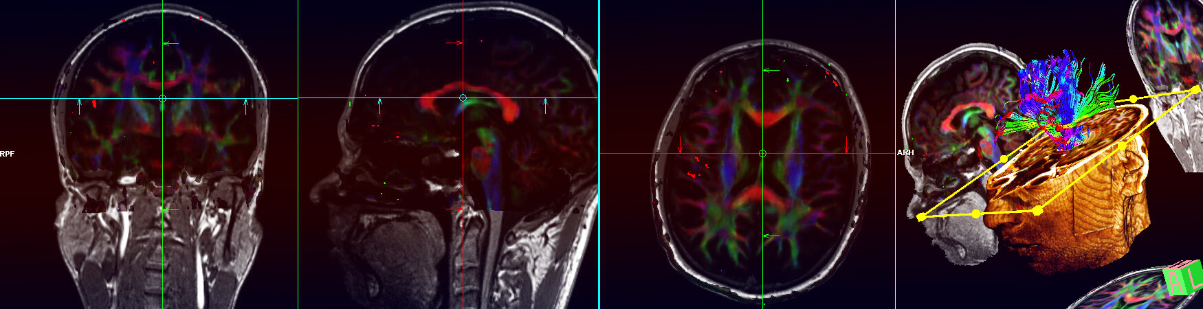 3 panels of MRI brain scans